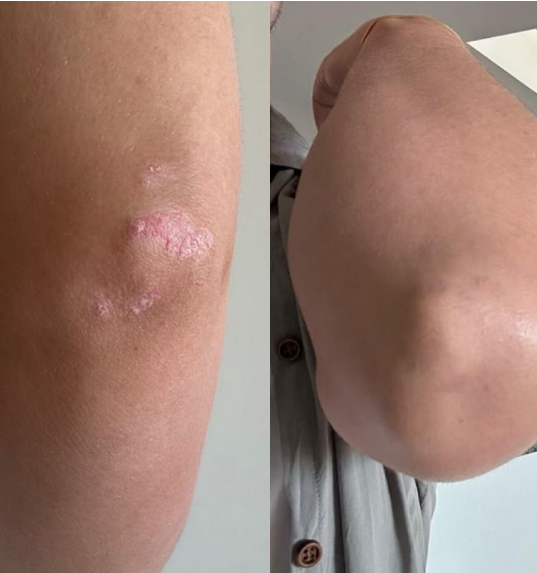 psoriasis