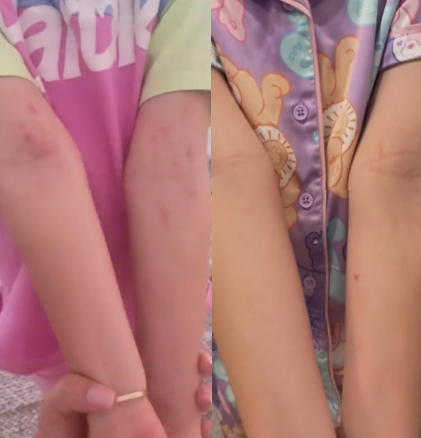 psoriasis