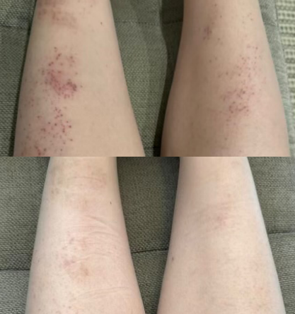 psoriasis