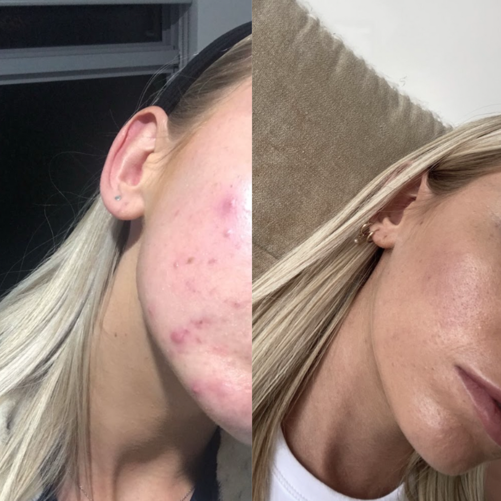 acne